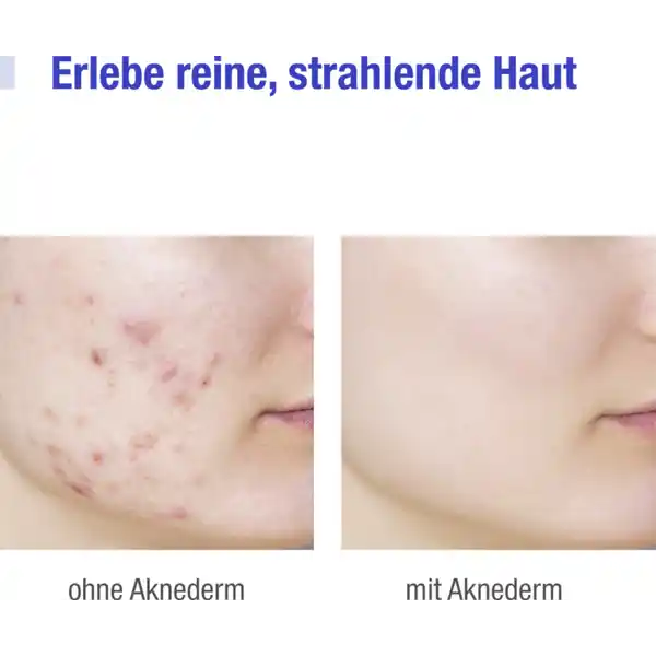 Creme zur Behandlung von Hautunreinheiten